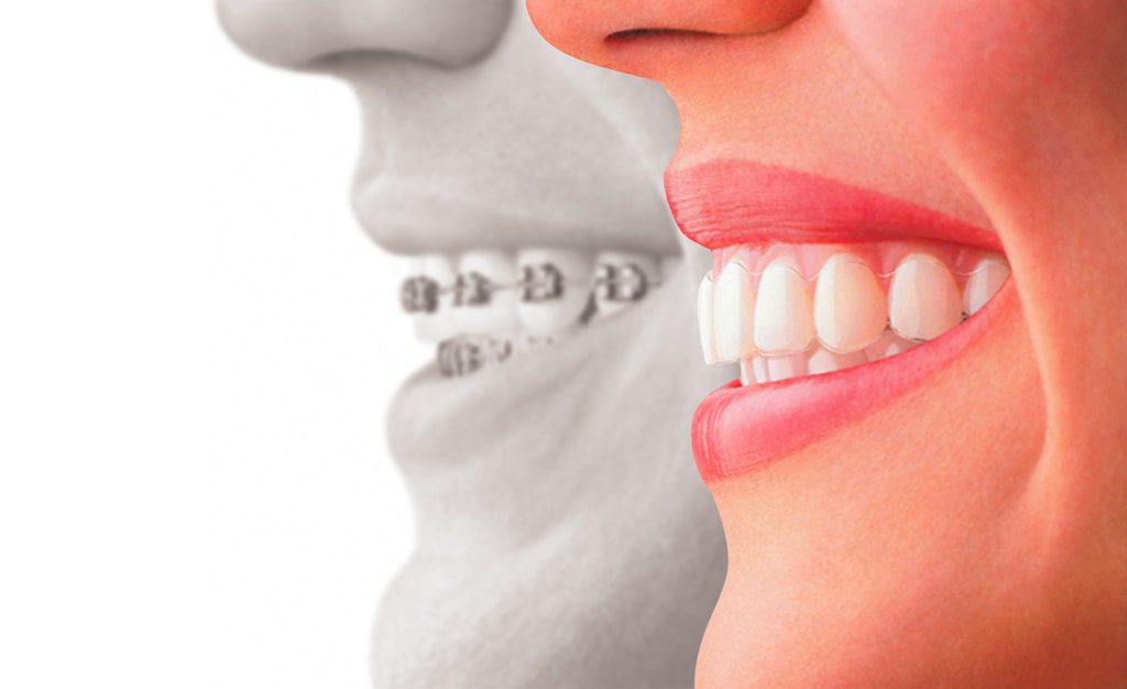 ortodoncia invisible - clínica dental en sevilla - centro bucodental